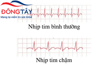 Nhịp tim chậm có thể do tác dụng phụ của thuốc tâyNhịp tim chậm có thể do tác dụng phụ của thuốc tây