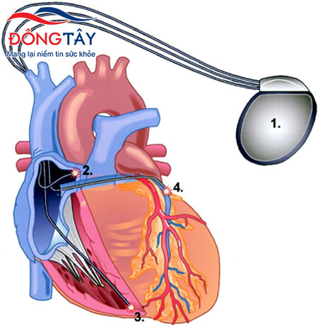 Đặt máy tạo nhịp tim là lựa chọn điều trị gần như số 1 cho người nhịp tim chậm