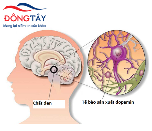 Nguyên nhân gây bệnh Parkinson là do thoái hóa các tế bào thần kinh sản xuất Dopamin