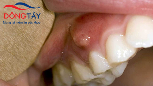 Sưng là một trong những dấu hiệu điển hình của bệnh nướu răng