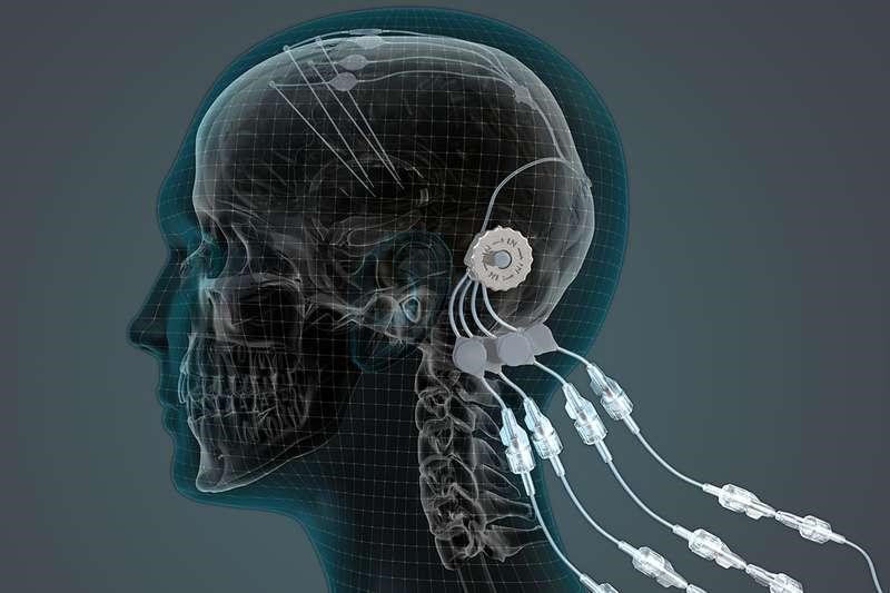 Các nhà nghiên cứu đưa ra một thiết bị tiên tiến cho phép đưa thuốc trực tiếp vào não bộ