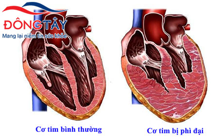 Suy tim kéo dài có thể dẫn đến phì đại cơ tim