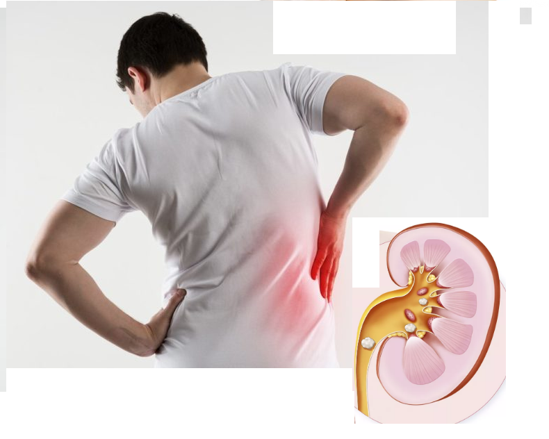 Sỏi thận thường gây đau vùng bụng dưới, bên sườn
