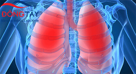 Suy tim sung huyết làm cho máu ứ lại ở phổi gây khó thở và ho