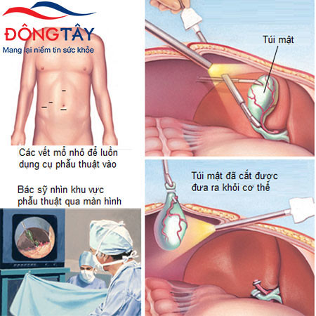Mổ sỏi túi mật chủ yếu thực hiện bằng phẫu thuật nội soi